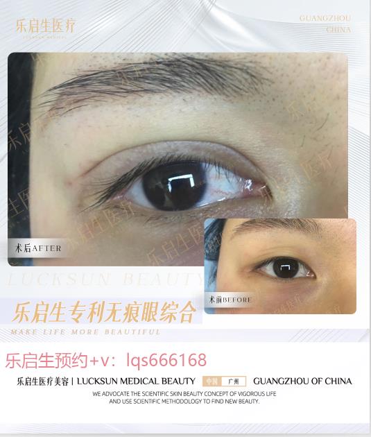 【樂啟生門診】日式雙眼皮是什么？手術之后需要注意什么？